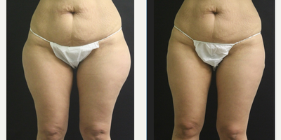Laser Liposuction before and after photo