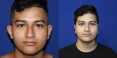 Rhinoplasty before and after photo
