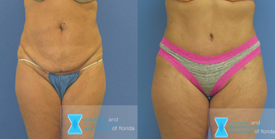 Tummy Tuck before and after photo