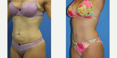 Tummy Tuck before and after photo