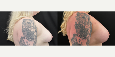 Vaser Liposuction before and after photo