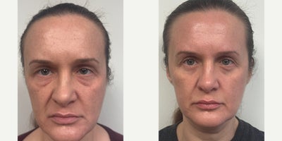 Eyelid Surgery before and after photo