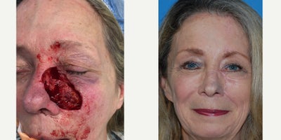 Facial Reconstructive Surgery before and after photo