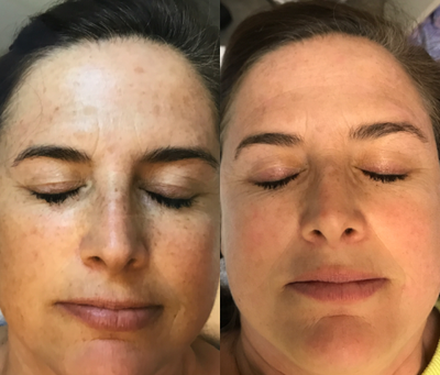 Laser Resurfacing before and after photo