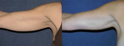 Arm Lift before and after photo