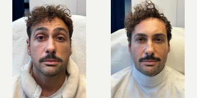 Botox before and after photo