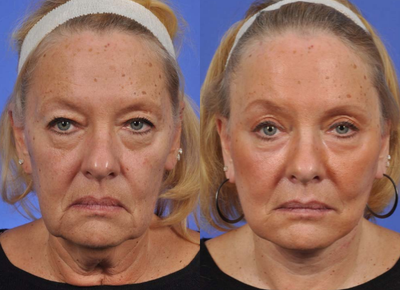 Cheek Lift before and after photo