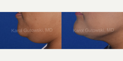Chin Liposuction before and after photo