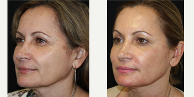 Dermal Fillers before and after photo