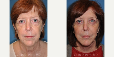 Eyelid Surgery before and after photo