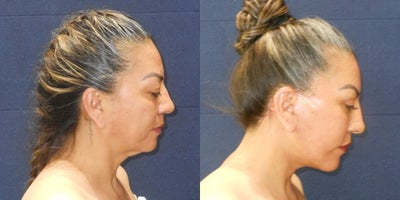 Facelift before and after photo
