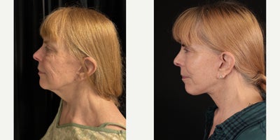 Facelift before and after photo