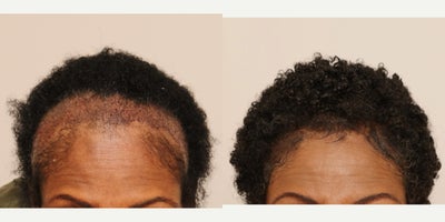 Hair Transplant before and after photo