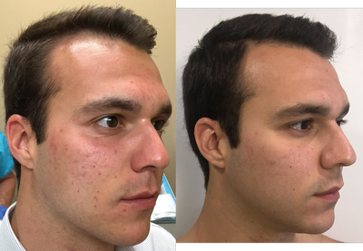 Halo Laser before and after photo