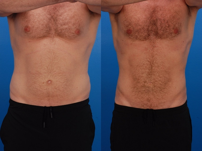 Liposuction before and after photo