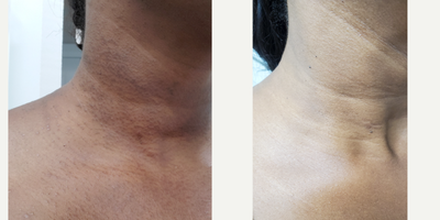 Skin Rejuvenation before and after photo