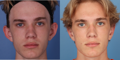Ear Surgery before and after photo