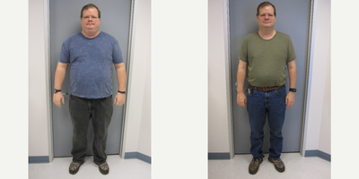 Gastric Bypass before and after photo