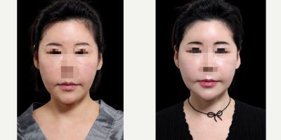 Neck Lift before and after photo