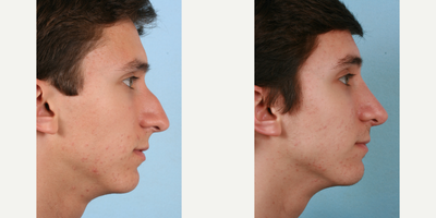 Rhinoplasty before and after photo