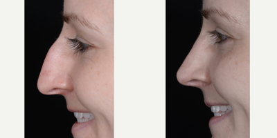 Rhinoplasty before and after photo
