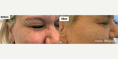 Botox before and after photo