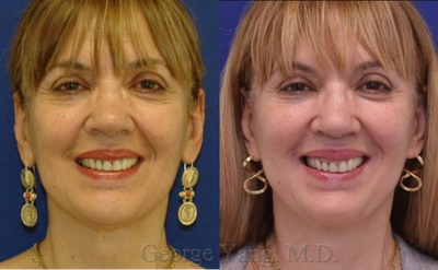 Facelift before and after photo
