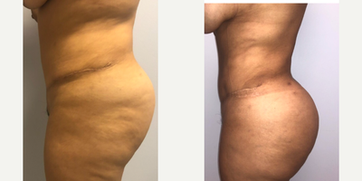 Brazilian Butt Lift before and after photo