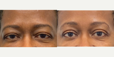 Brow Lift before and after photo