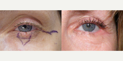 Eyelid Surgery before and after photo