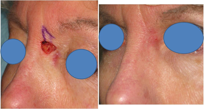 Mohs Surgery before and after photo