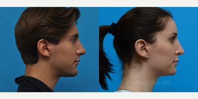 Transgender Facial Feminization Surgery before and after photo