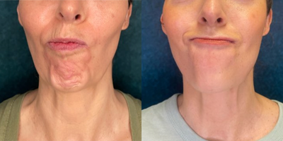 Xeomin before and after photo