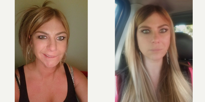 Botox before and after photo