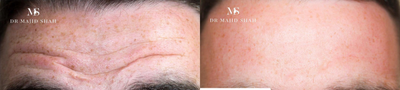 Botox before and after photo