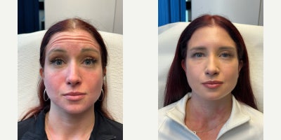 Botox before and after photo