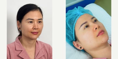 Brow Lift before and after photo