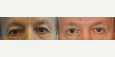 Eyelid Surgery before and after photo