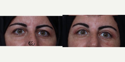 Eyelid Surgery before and after photo