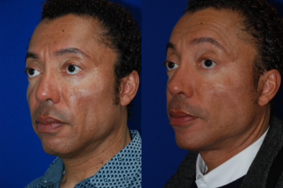 Facelift before and after photo