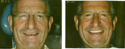 Porcelain Veneers before and after photo