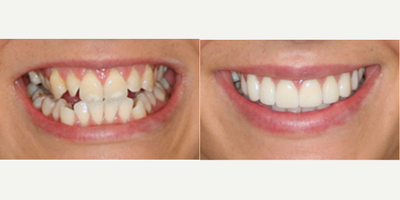 Porcelain Veneers before and after photo