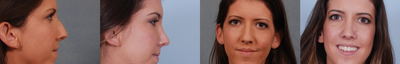 Rhinoplasty before and after photo