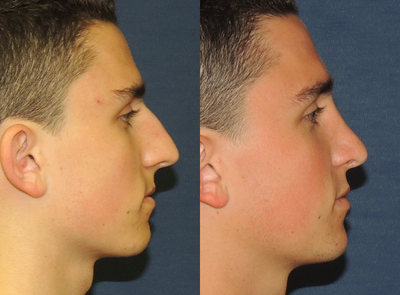 Rhinoplasty before and after photo