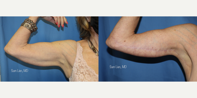 Arm Lift before and after photo