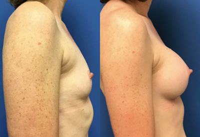 Breast Augmentation before and after photo