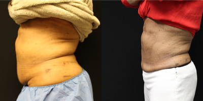 CoolSculpting before and after photo