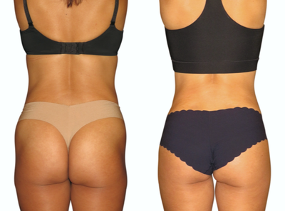 Renuvion before and after photo