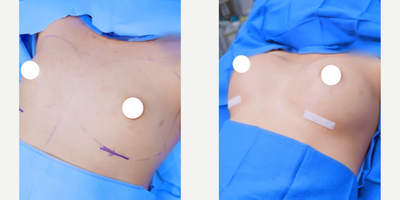 Breast Augmentation before and after photo