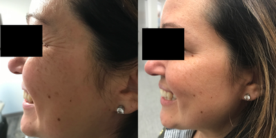Dysport before and after photo
